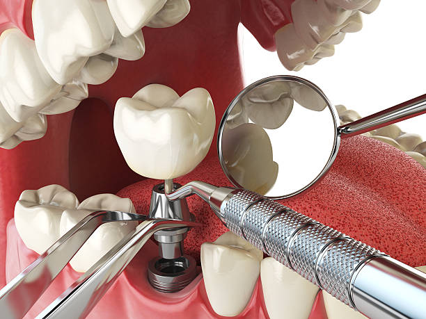 Best Broken or Cracked Tooth Emergency Dentist in Northport, NY